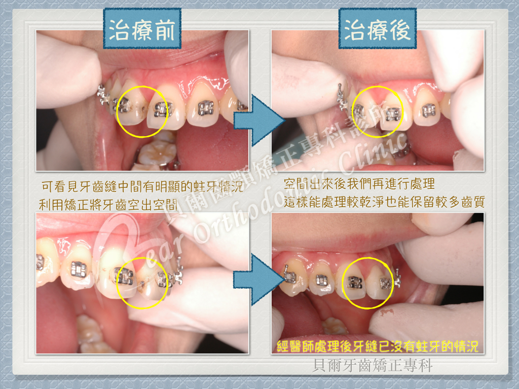 蕭琬蓉 牙縫蛀牙_002 貝爾牙醫矯正案例
