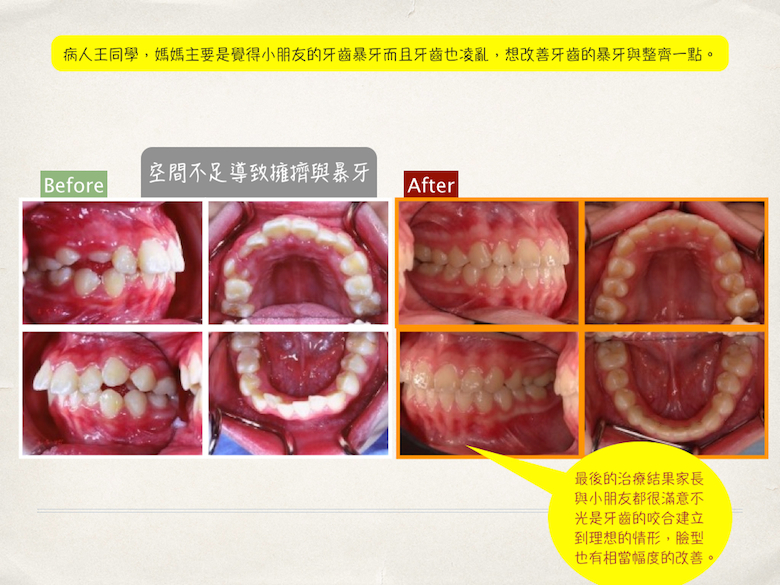 貝爾牙醫矯正案例