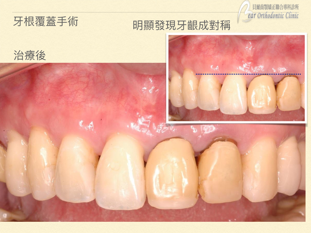 貝爾牙醫矯正案例